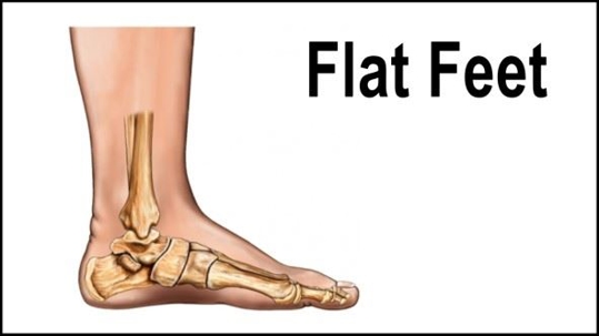 Flat feet diagram